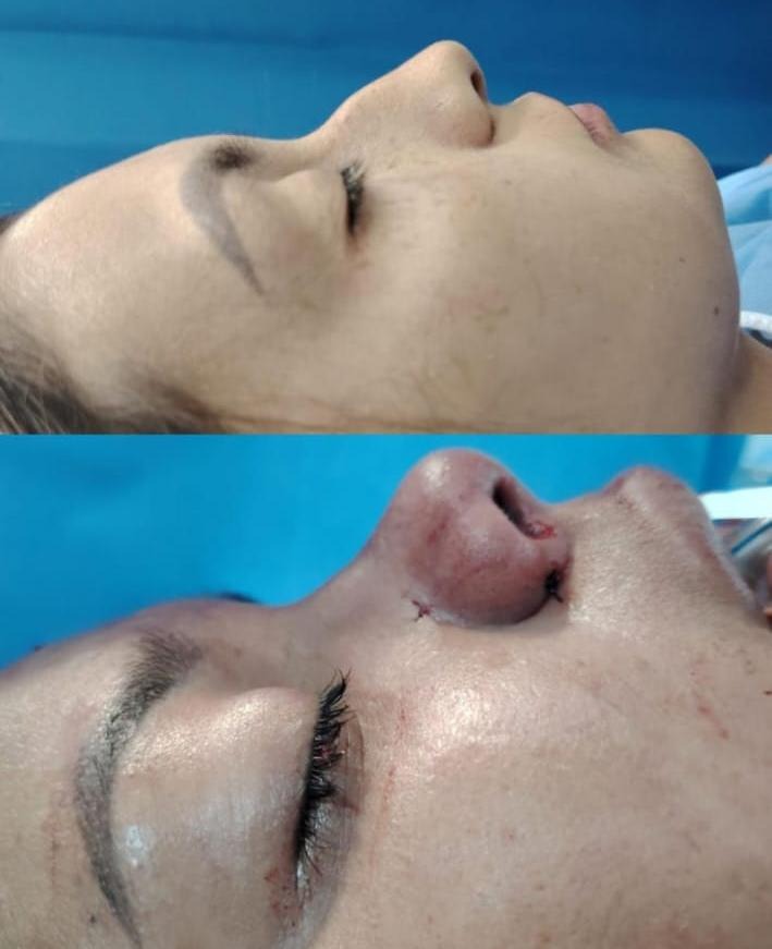 Rinoplastia